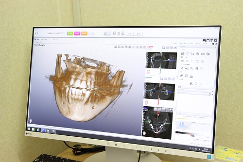 歯科用ＣＴ