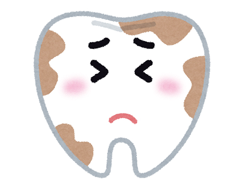 3．虫歯菌のかたまりである歯垢（プラーク）が歯の表面に形成され、酸を産生