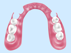 バネのない部分入れ歯「ノンクラスプデンチャー」