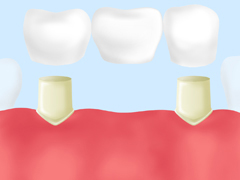 保険適応で治療が可能「ブリッジ」