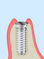 人工歯根 埋め込み